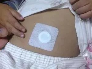 小兒積滯，秘密武器來(lái)幫你——敷貼器